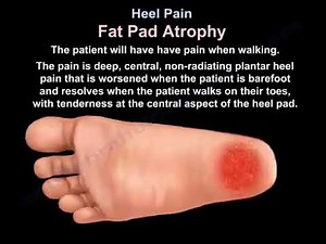 Heel Pain, causes, diagnosis, and treatment. Plantar fascitis.