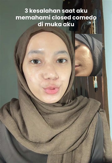 Mengatasi Closed Comedo: 3 Kesalahan Umum