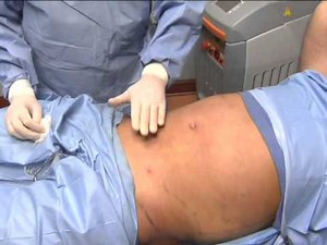 Smartlipo Atlanta Laser Liposuction Demonstration Part II