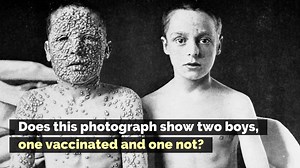 12K views · 189 reactions | Fact Check: Does this photograph show two boys — one vaccinated, one not — who were exposed to smallpox? Full Report: https://trib.al/zzNnhsM | snopes.com | Facebook