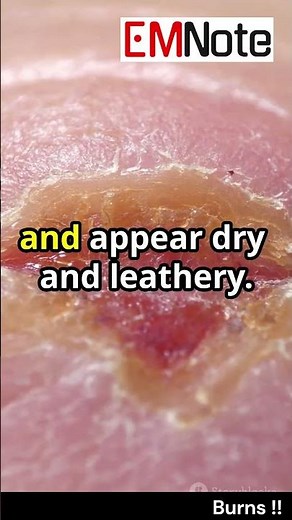 Burns First Aid #nursing #doctor #medical