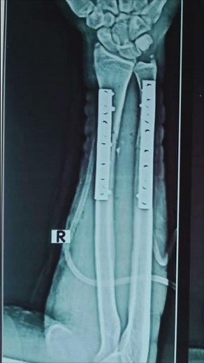 Dynamic compression plate (DCP) for Radius & Ulna Fracture #radius #ulna #fracture #plate #ortho