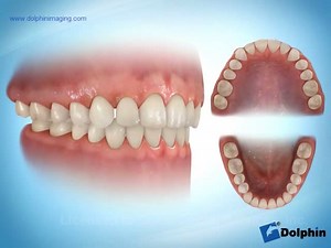 Class 1 Crossbite Buccal