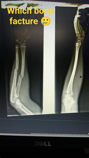 #tag radius ulna bone facture 🥲 #tag radiology technician 👍 #tag you tube short video #tagsforlikes
