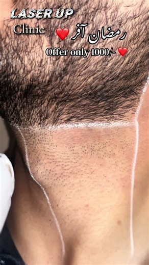 Ramadan Offer: Affordable Laser Hair Removal at Laser Up Clinic