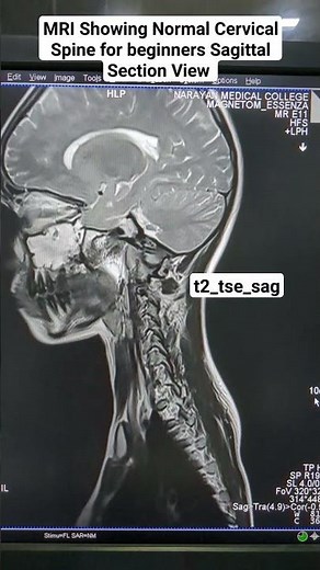 MRI t2_tse_sag Sequence Showing Normal Cervical Spine for Beginners #anatomy
