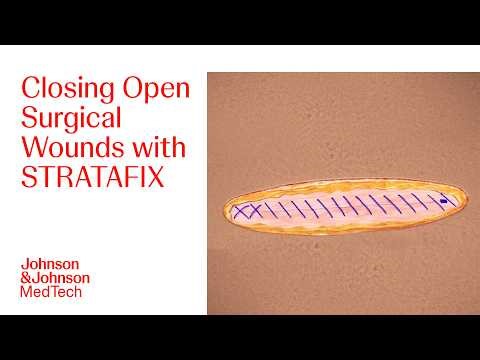 Suturing Techniques for Optimal Wound Closure with STRATAFIX in Open Surgery | J&J MedTech