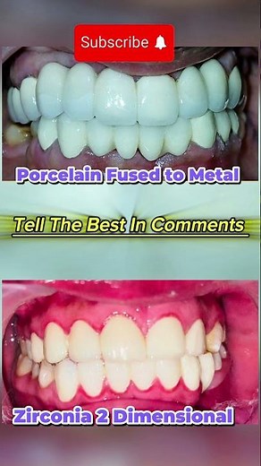 Zirconia Vs PFM | Porcelain Fused to Metal | Zirconium Bridge #dentist #dentaltreatment #satisfying