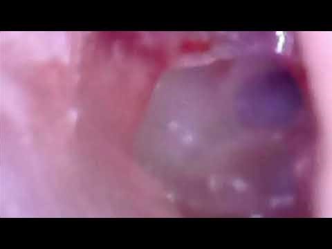 CRACKER BLAST INDUCED DRUM PERFORATION