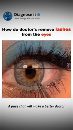 Ayush Kumar on Instagram: "Doctors carefully remove eyelashes from the eye using precise and sterile techniques 👁️✨ First, they inspect the eye under bright light or a slit lamp to locate the lash. If it’s loose, a sterile saline flush may remove it easily. When it’s stuck, fine tweezers or a moist cotton swab help lift it gently — sometimes after flipping the eyelid for better access. After removal, soothing eye drops or antibiotics are used to protect and heal the eye. credit : life_withmedic