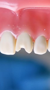 Fixing a Chipped Tooth: Real Dentist Procedure | 5-Minute Workouts