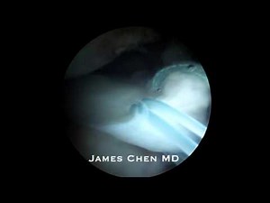 Arthroscopic Lateral Meniscus Root Repair