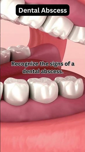 Understand how acid erosion damages tooth enamel. #dentist #dentalcaretips #nursing