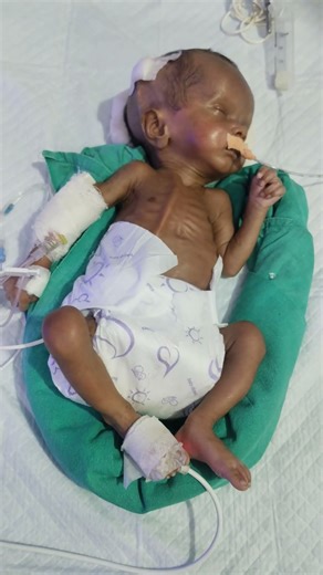 #hydrocephalus operation baby # nursing care staff hospital 🏥