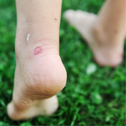 Deroofed Blisters: Here's What You Need To Know