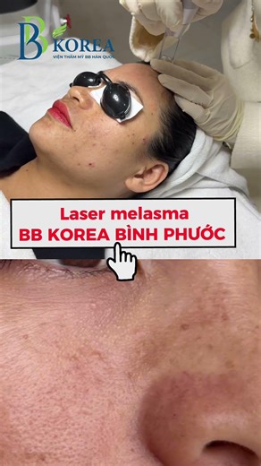 Laser Pico Ngày Đầu: Nền Da Khỏe – Nám Tan Biến