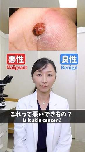 【皮膚科医が解説】このできもの、悪性？良性？