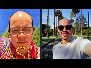 What It's Like Going Bald at 18