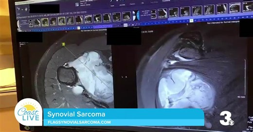 Understanding Synovial Sarcoma during Sarcoma Awareness Month on Coast Live