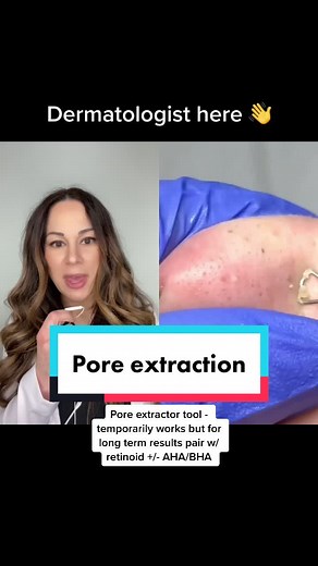 #duet with @dremanabdallah #pores #poreextraction #pimplepopping #diyskin #whiteheads #acne