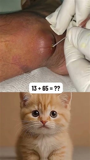 Removing large blackheads and pimples from face new 2026 #11