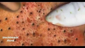 how to removal blackhead and how to get rid of blackhead blackhead on face #60 Most Favorite Videos: 1. A DrPimplePopper TBT: The ones that come out clean @ https://fb.com/321818478359649 2. Severe acne on the cheeks & Whitehead Removal Cyst Pimple Popping @ https://fb.com/620981811658515 3. Dr Pimple Popper's Best Punch Removals of 2016 @ https://fb.com/615077828951028 4. The biggest blackhead compilation, Big pimple popping @ https://fb.com/341999033106000 5. Removal Blackheads & Whiteheads On