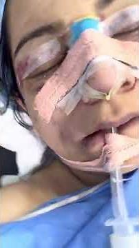 Facial Dimple Creation Surgery - Before and After