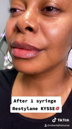 Restylane KYSSE Before and After Lip Injections by Beauty Nurse Roberta