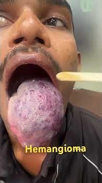 High Flow Compressible Hemangioma or AV Malformation on the Tongue