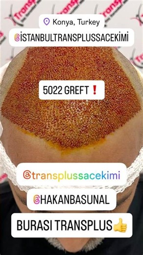 5022 #kök #saçekimi #saç #hair #hairtransformation #hairstyle #hairtransplant #konya