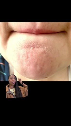 Understanding and Treating Sebaceous Filaments on Chin