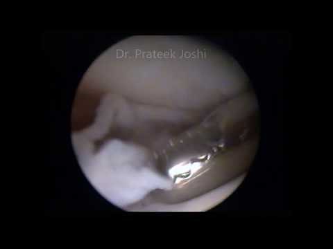 Arthroscopic Suprapatellar Plica Excision - Dr. Prateek Joshi