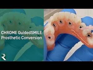 CHROME GuidedSMILE Prosthetic Conversion Process