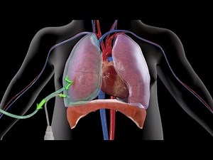 How Easy Treatment of Pneumothorax Could Have Been