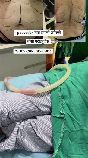 We are located at Kathmandu Anamnagar near bajeko sekuwa and bouddha opposite to taragaoun museum please contact at:9860777206/01-5707056 9768912947 / 9768912948 or you may find our exact location at google maps. We provide various injectable, laser as well as surgical treatments including hair transplant/ beard transplant/eyebrow transplant and many more…#drmainali #kccsdermatology #kccs #liposuction