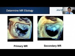 Joint Echo Conference: Structural Heart Mitral Valve Intervention