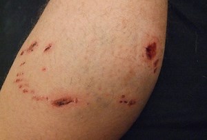 Dog bite, basic first aid tips for the victim | Emergency Live