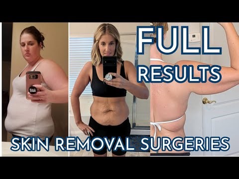 Skin Removal Surgery Results after Losing 100+ Pounds- Tummy Tuck, Brachioplasty, Back Lift