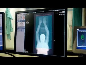 B/L UPPER LIMB ANGIOGRAPHY ON GE 16 SLICE
