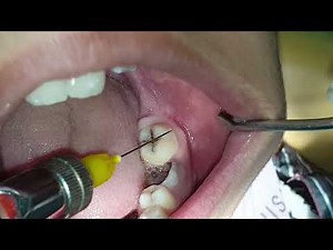Long buccal nerve anesthesia