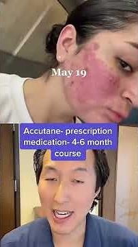 Incredible Cystic Acne Before and After! #shorts #acne