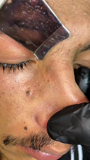 Effective Blackhead Removal Techniques for Clear Skin