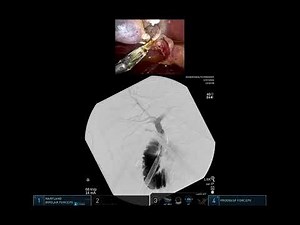 Robotic cholecystectomy with IOC and tilepro