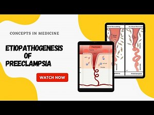 Etiopathogenesis Of Preeclampsia (Made Easy!!)