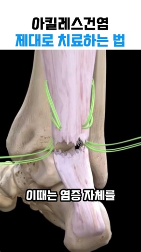 뒤꿈치에서 '툭' 소리와 극심한 통증? 아킬레스건 파열 수술 과정과 재발 방지법 #발건강 #발뒤꿈치통증 #발바닥통증 #족저근막염 #종아리통증 #아킬레스건염 #아킬레스건