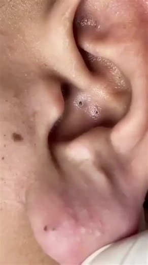 blackheadextraction (@blackheadrm)’s videos with original sound - blackheadextraction