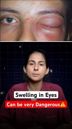 Swelling Below the Eyelid With Fever? It Could Be Cellulitis!
