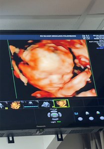 USG Kandungan: Melihat Perkembangan Janin Bayi