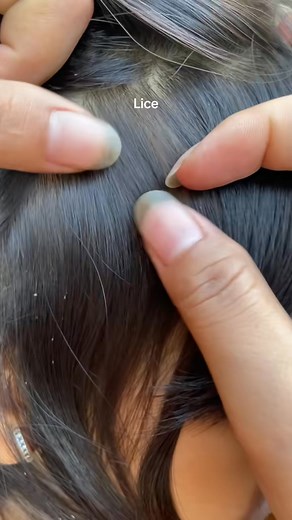 75K views · 412 reactions | Nhà m có ai có con đi học bị lây chấy ko. Ib e có bài thuốc trị sạch chấy và trứng chấy chỉ 1 lần sử dụng hiệu quả  mà không bị lại.Luôn tuyển sỉ đại lý trên toàn quốc a. 0399769374 | NPP Rượu ủ chấy gia truyền | Facebook