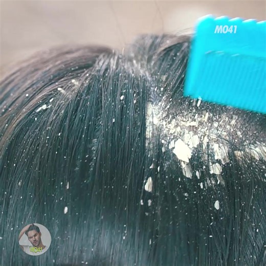 My favorite watch dandruff scratching technique 77 | MO41